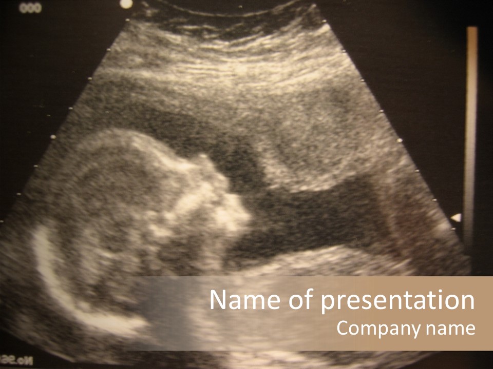 Fetus Ultra Smile PowerPoint Template