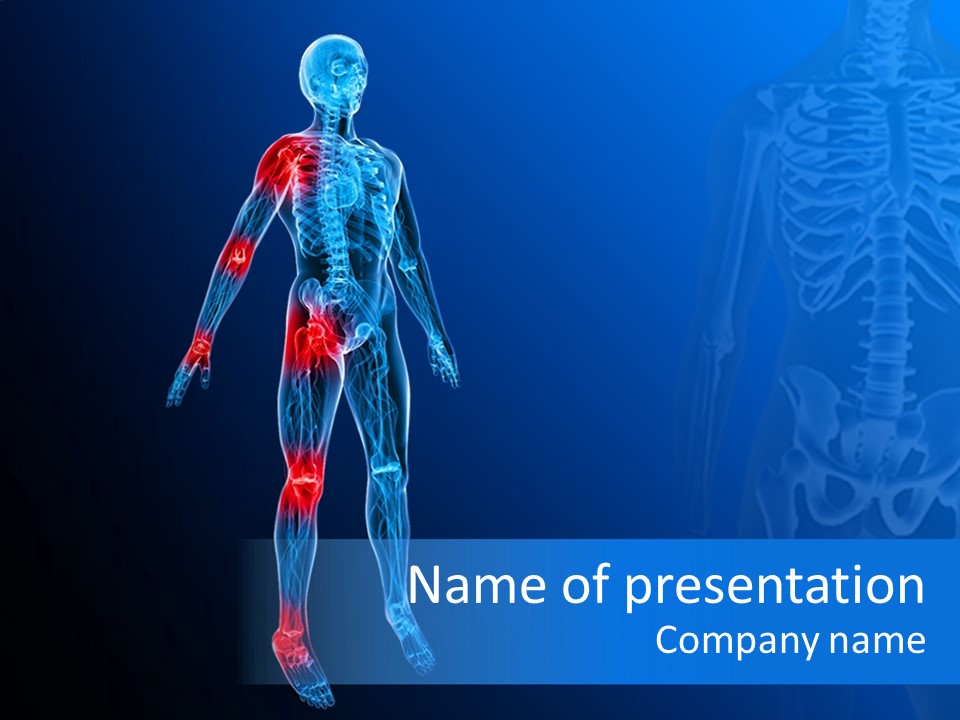 Ilium Painful Osteoporosis PowerPoint Template