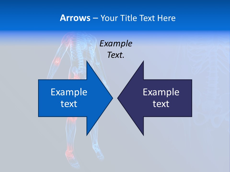 Ilium Painful Osteoporosis PowerPoint Template