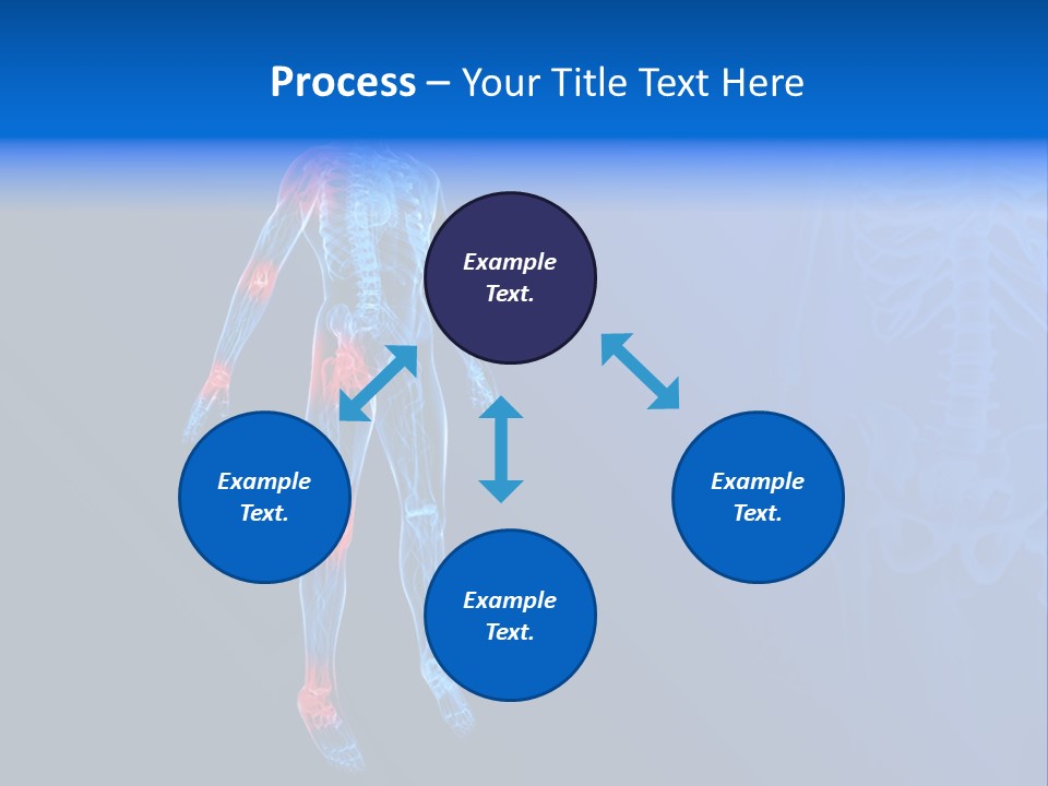 Ilium Painful Osteoporosis PowerPoint Template