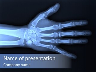 Broken Body Thumb PowerPoint Template