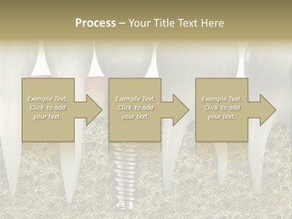 Orthodontist Steel Dentist PowerPoint Template