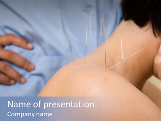 A Woman Getting Acupulations On Her Back With Needles PowerPoint Template