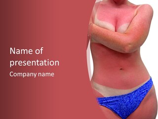 A Woman's Body With A Bad Case Of Sunburn. Isolated On White Background And Includes Clipping Path. PowerPoint Template