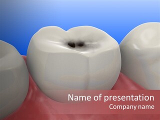 Caries PowerPoint Template