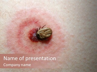 Tick On Skin PowerPoint Template