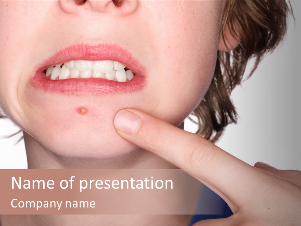 Pimple PowerPoint Template