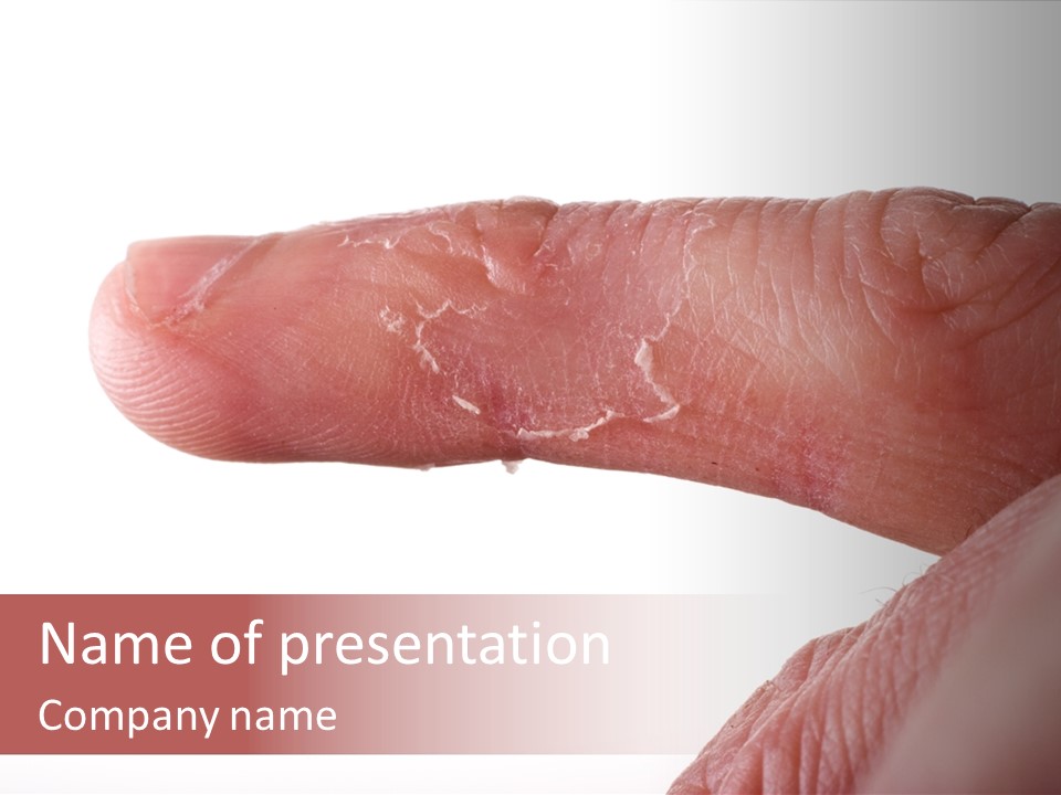 Closeup Of Eczema On Male Finger With Skin Peeling PowerPoint Template