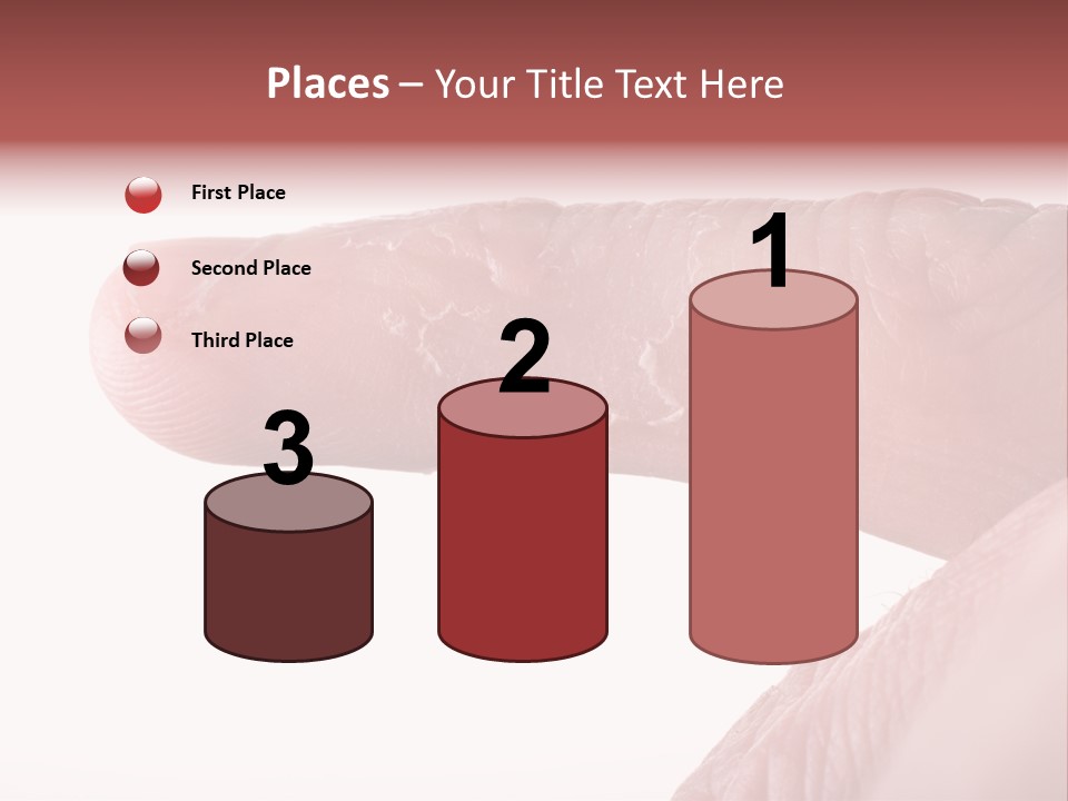 Closeup Of Eczema On Male Finger With Skin Peeling PowerPoint Template