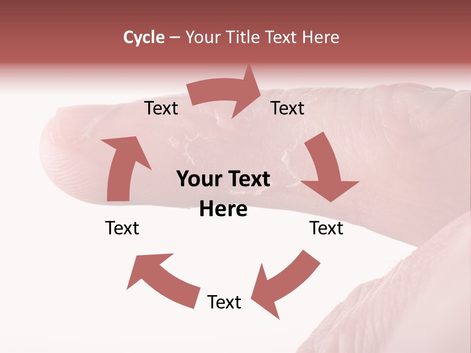 Closeup Of Eczema On Male Finger With Skin Peeling PowerPoint Template