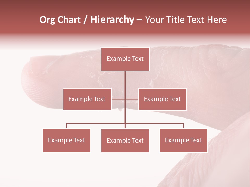 Closeup Of Eczema On Male Finger With Skin Peeling PowerPoint Template