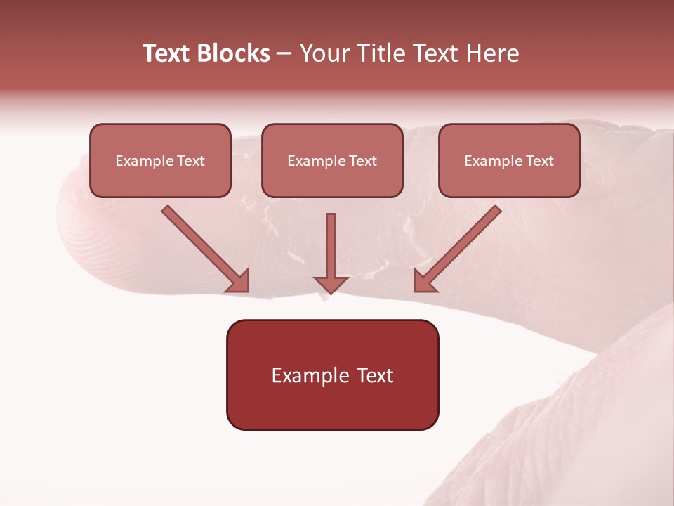 Closeup Of Eczema On Male Finger With Skin Peeling PowerPoint Template
