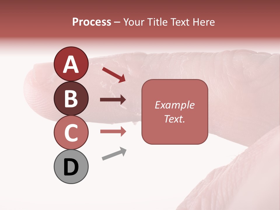 Closeup Of Eczema On Male Finger With Skin Peeling PowerPoint Template
