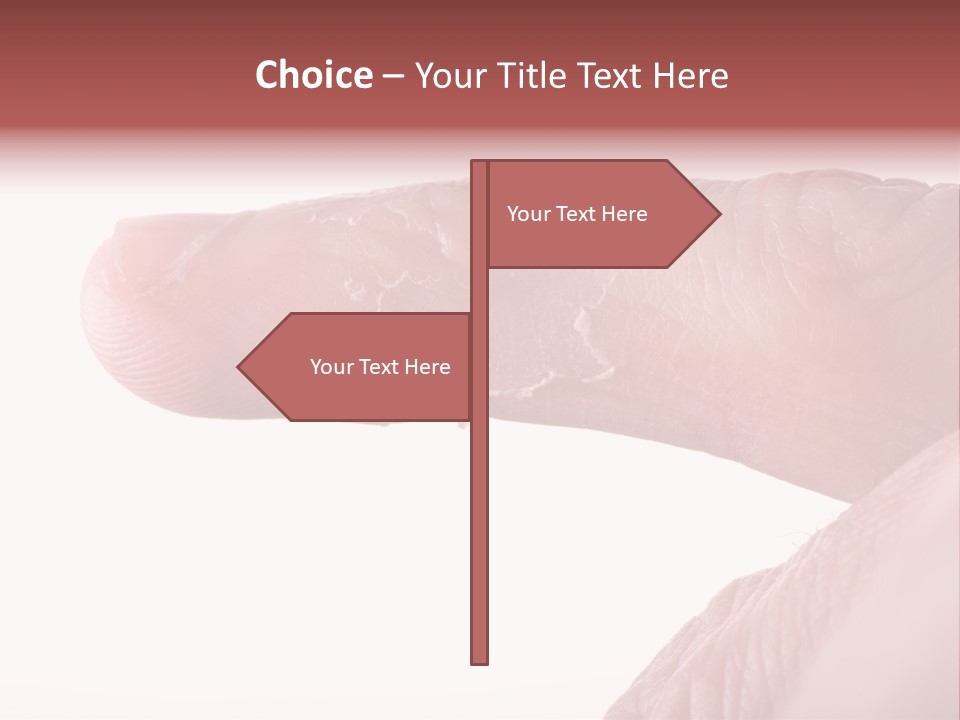 Closeup Of Eczema On Male Finger With Skin Peeling PowerPoint Template