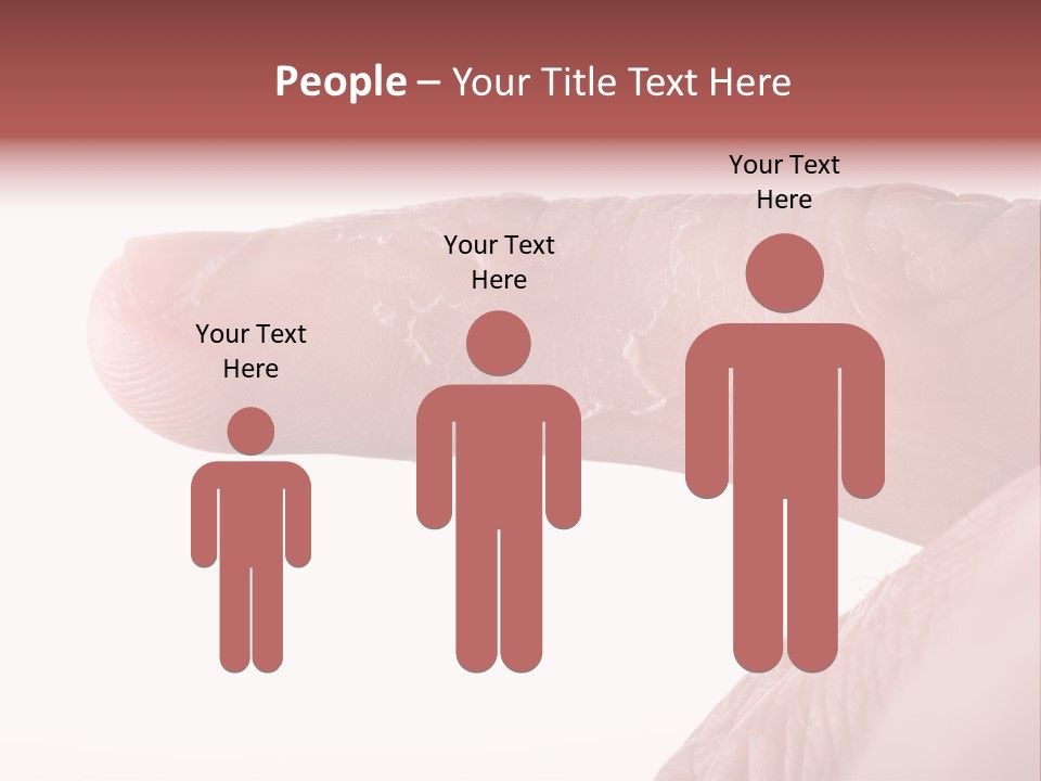 Closeup Of Eczema On Male Finger With Skin Peeling PowerPoint Template