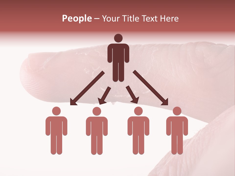 Closeup Of Eczema On Male Finger With Skin Peeling PowerPoint Template