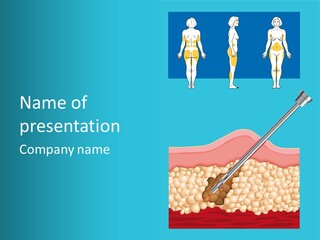 Illustration Of Liposuction Intervention With Liposculpture In A Woman PowerPoint Template