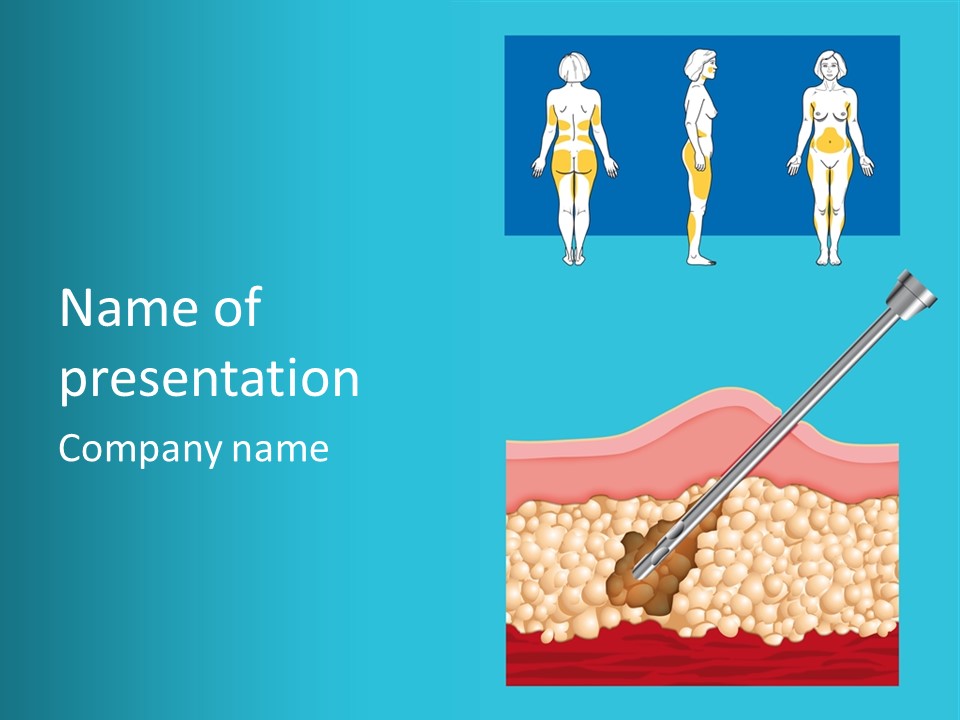 Illustration Of Liposuction Intervention With Liposculpture In A Woman PowerPoint Template