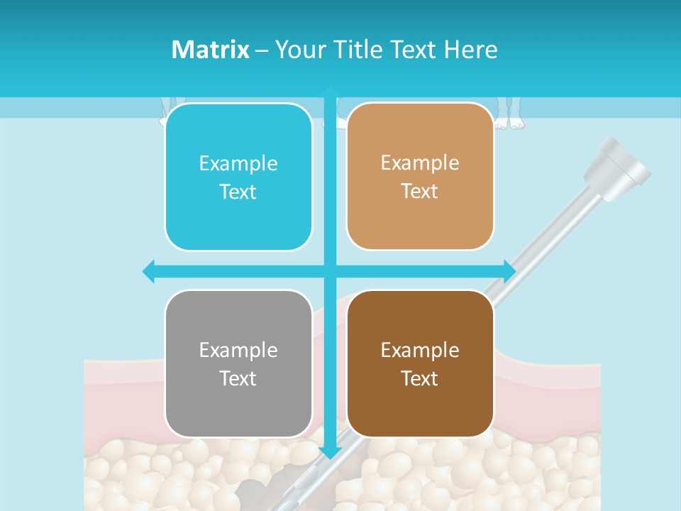 Illustration Of Liposuction Intervention With Liposculpture In A Woman PowerPoint Template