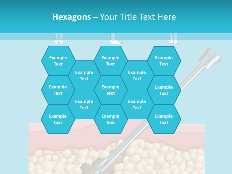 Illustration Of Liposuction Intervention With Liposculpture In A Woman PowerPoint Template