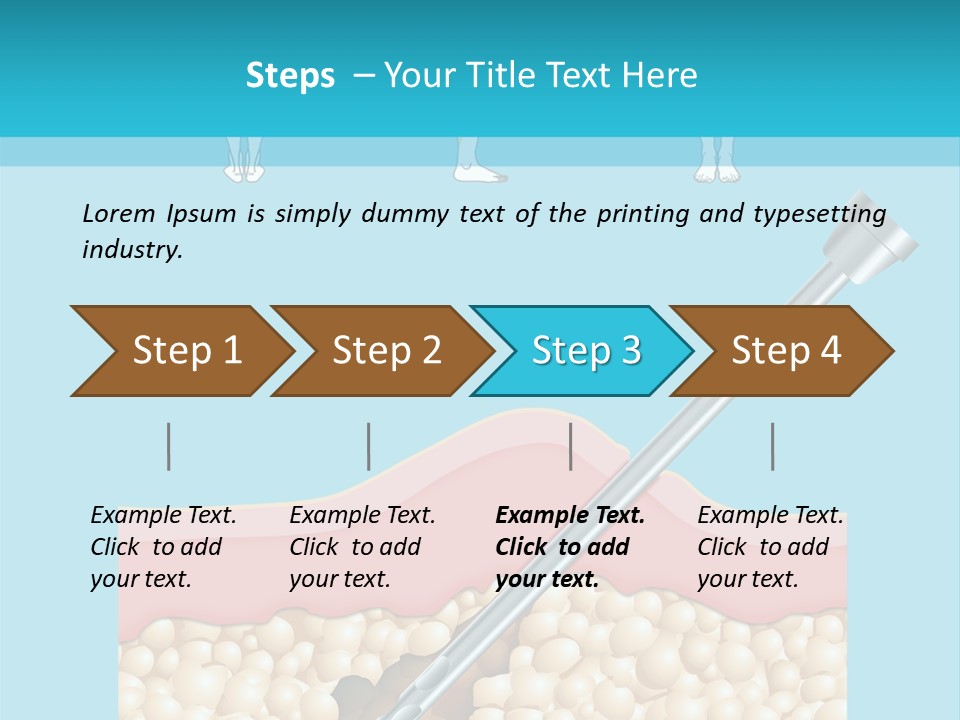 Illustration Of Liposuction Intervention With Liposculpture In A Woman PowerPoint Template