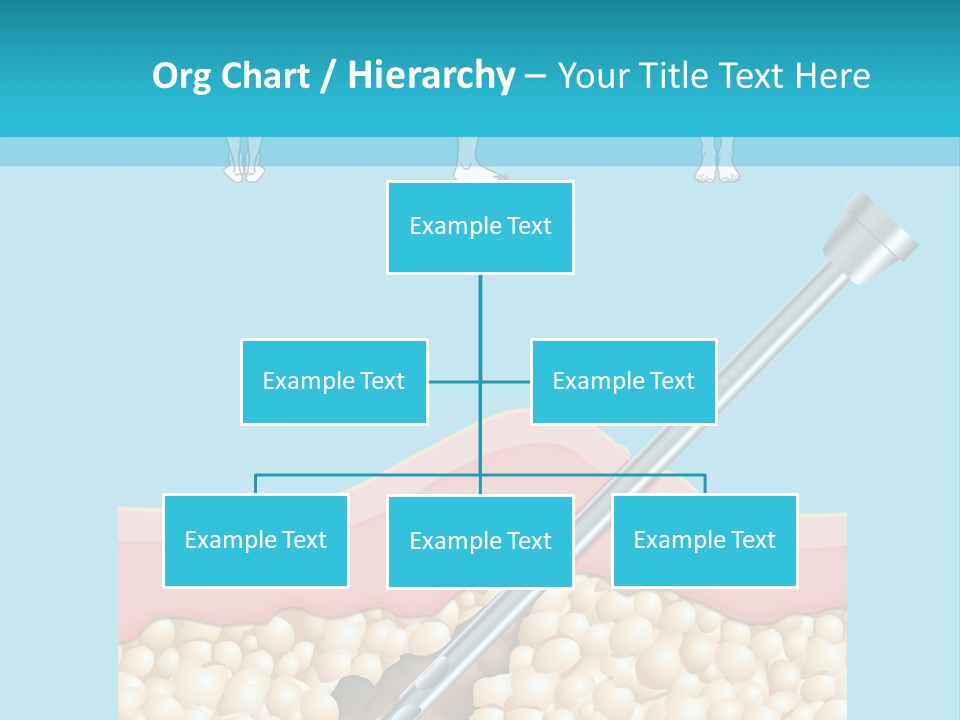 Illustration Of Liposuction Intervention With Liposculpture In A Woman PowerPoint Template