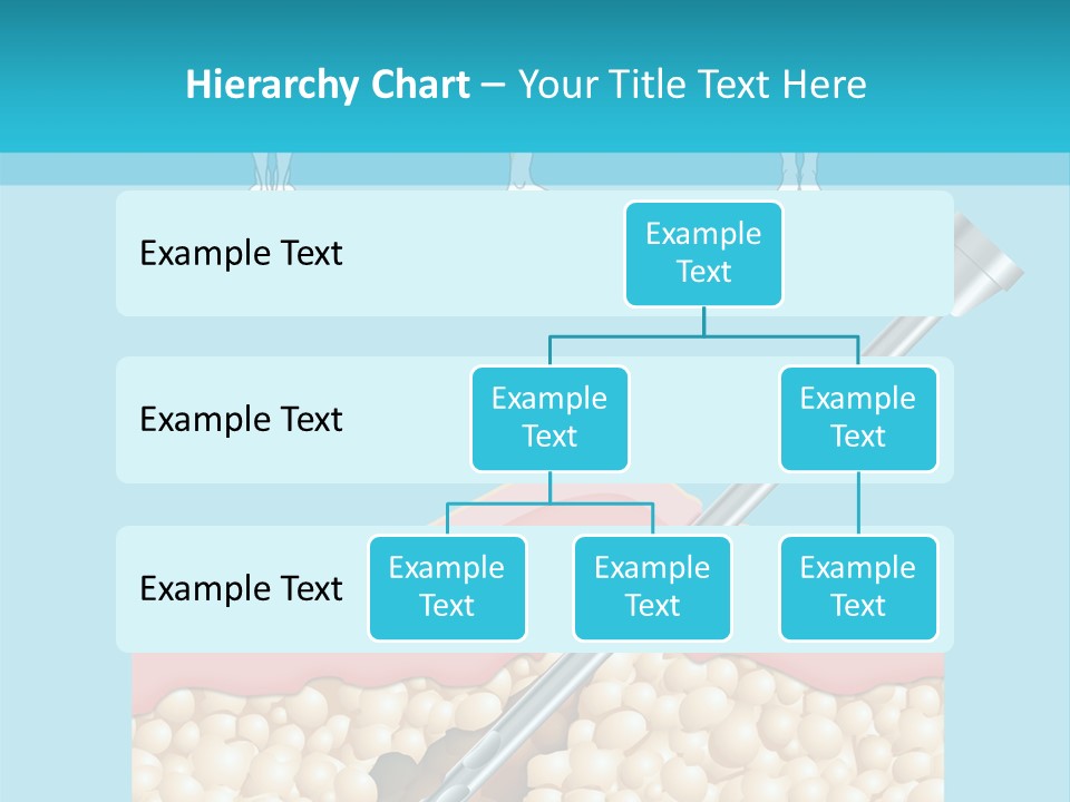 Illustration Of Liposuction Intervention With Liposculpture In A Woman PowerPoint Template