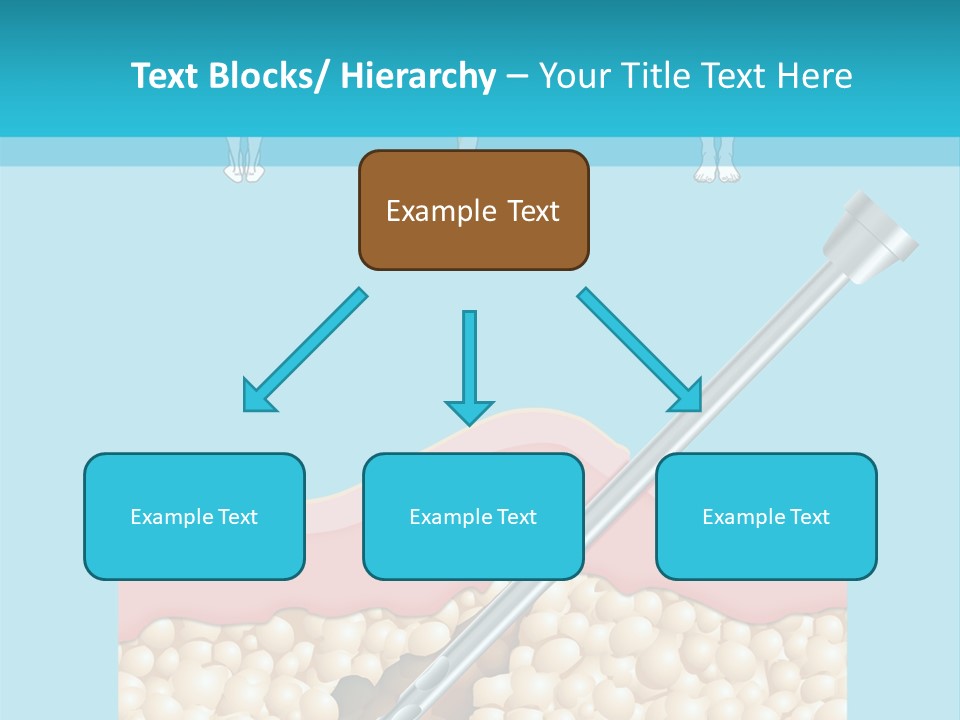 Illustration Of Liposuction Intervention With Liposculpture In A Woman PowerPoint Template