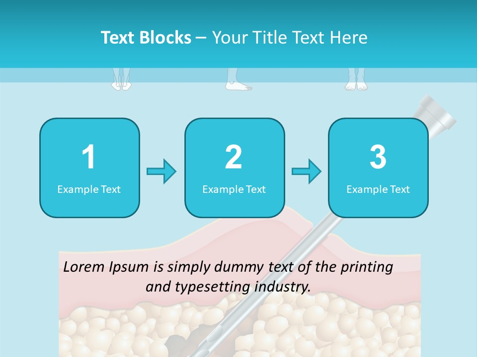 Illustration Of Liposuction Intervention With Liposculpture In A Woman PowerPoint Template