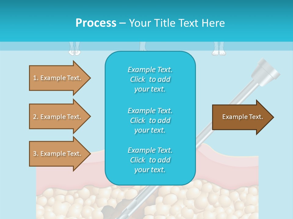 Illustration Of Liposuction Intervention With Liposculpture In A Woman PowerPoint Template
