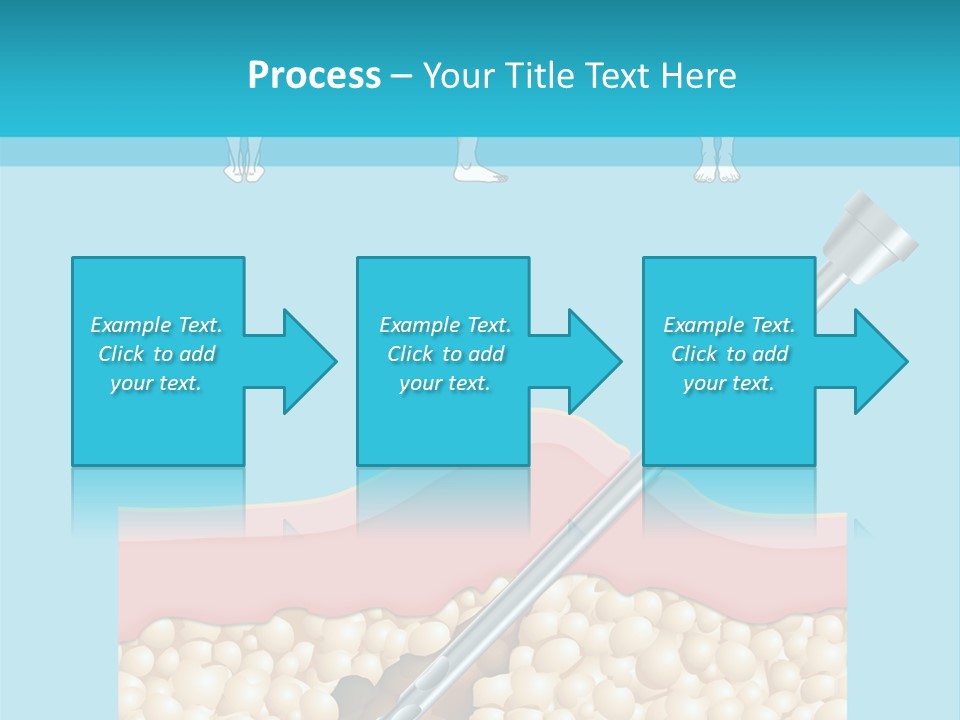Illustration Of Liposuction Intervention With Liposculpture In A Woman PowerPoint Template
