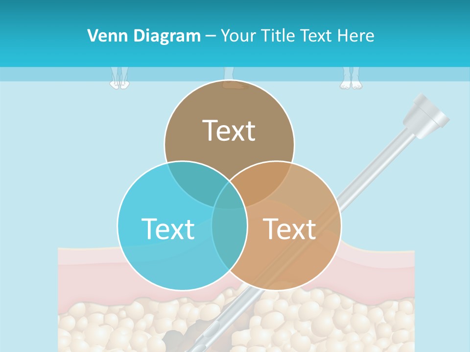Illustration Of Liposuction Intervention With Liposculpture In A Woman PowerPoint Template