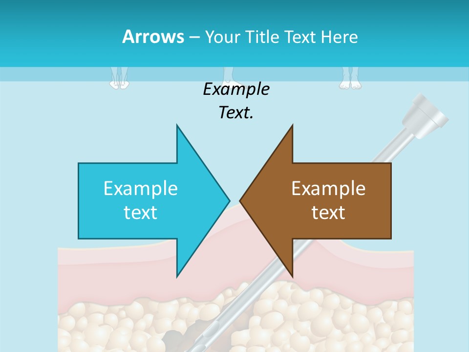 Illustration Of Liposuction Intervention With Liposculpture In A Woman PowerPoint Template