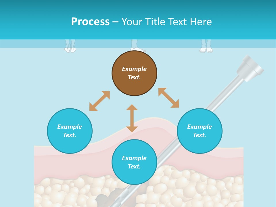 Illustration Of Liposuction Intervention With Liposculpture In A Woman PowerPoint Template