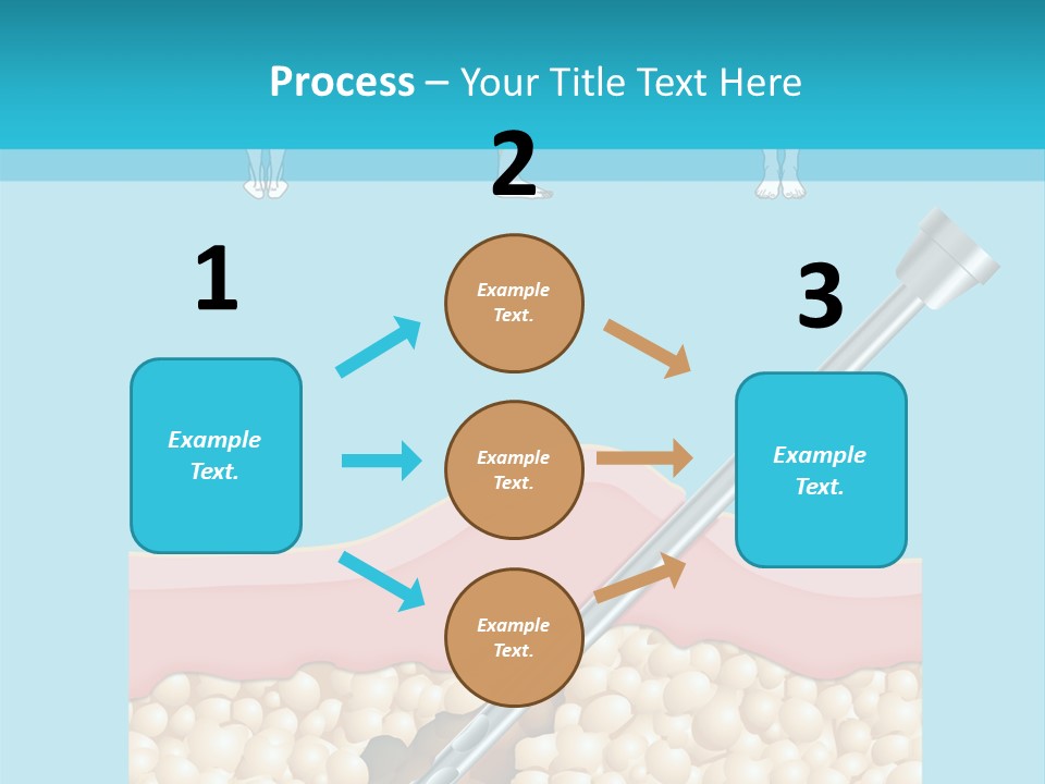 Illustration Of Liposuction Intervention With Liposculpture In A Woman PowerPoint Template