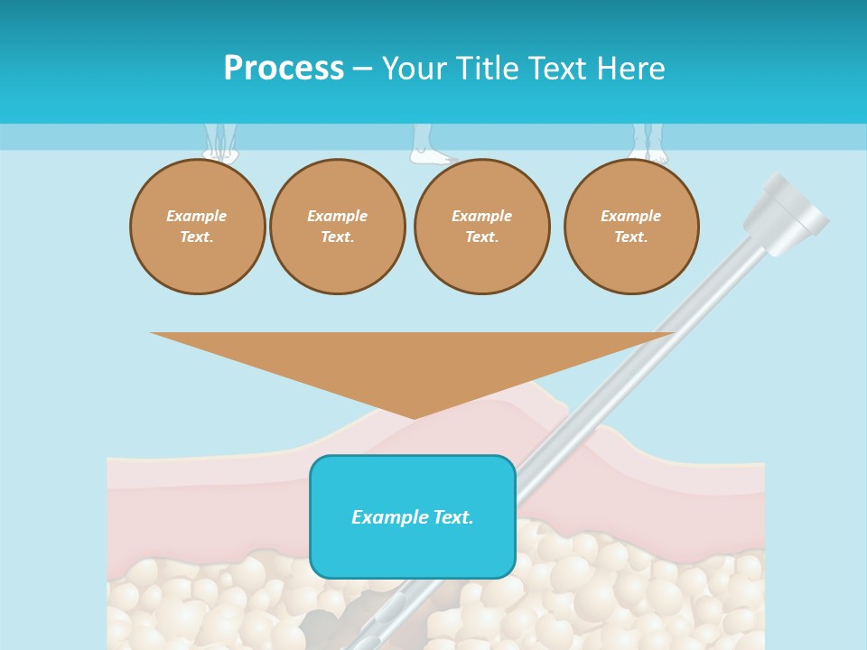 Illustration Of Liposuction Intervention With Liposculpture In A Woman PowerPoint Template