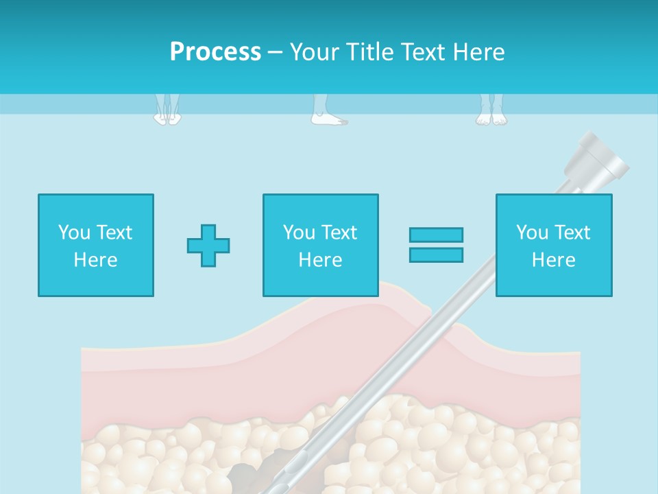 Illustration Of Liposuction Intervention With Liposculpture In A Woman PowerPoint Template