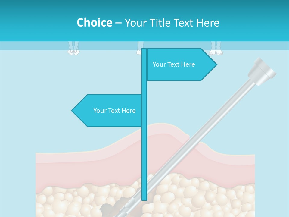 Illustration Of Liposuction Intervention With Liposculpture In A Woman PowerPoint Template