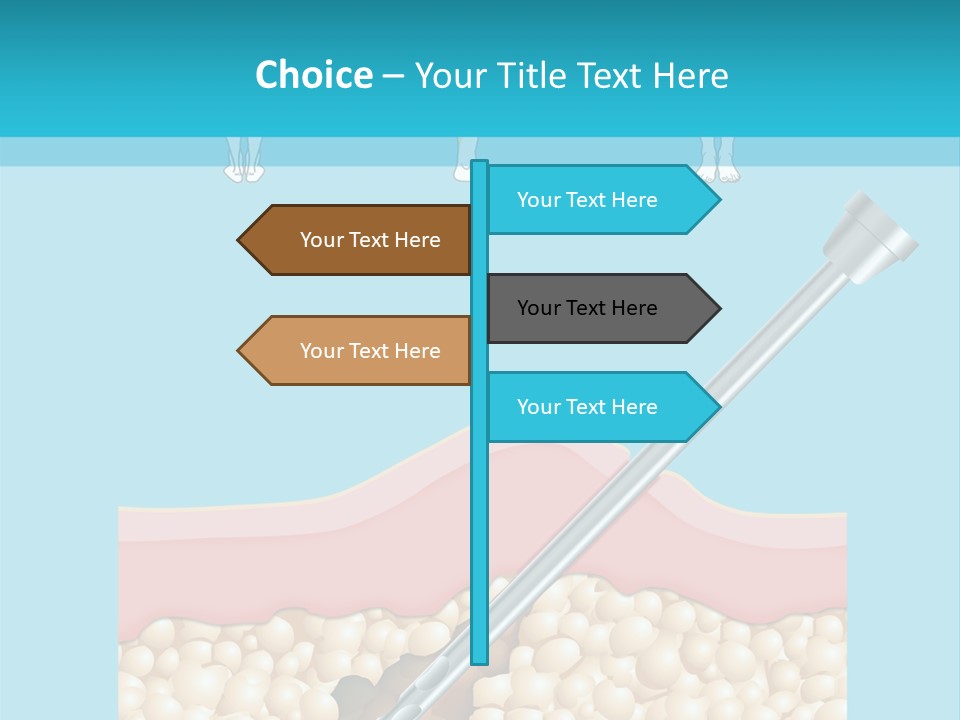 Illustration Of Liposuction Intervention With Liposculpture In A Woman PowerPoint Template