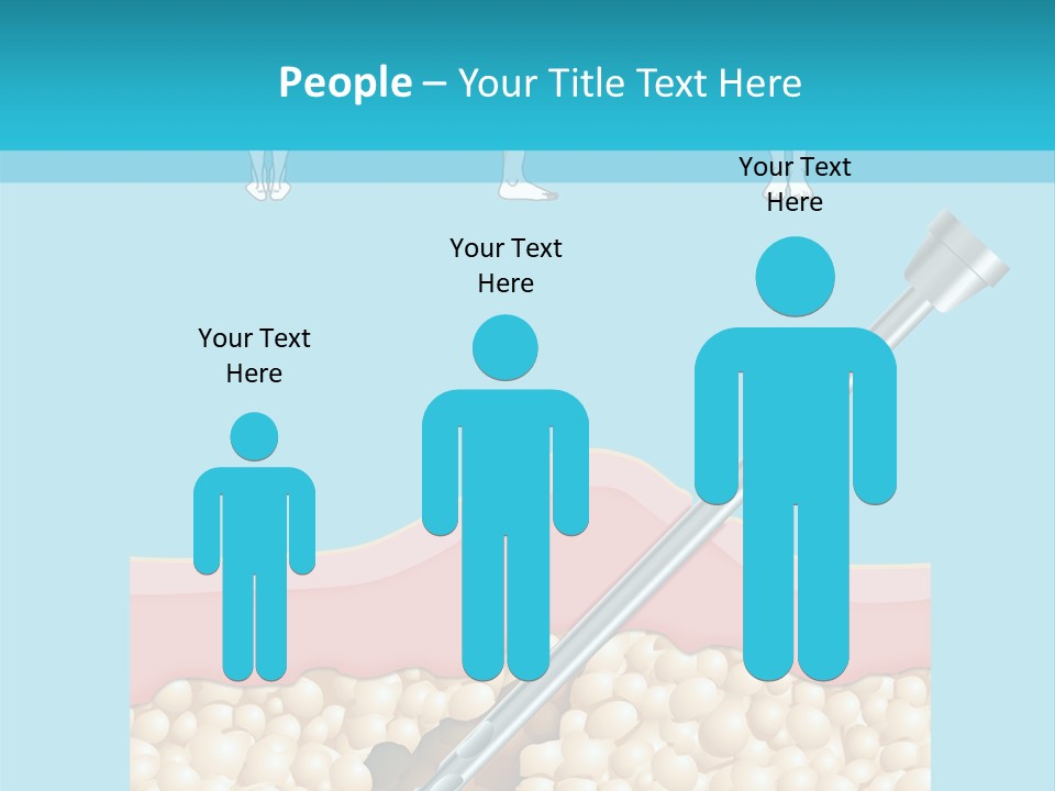 Illustration Of Liposuction Intervention With Liposculpture In A Woman PowerPoint Template