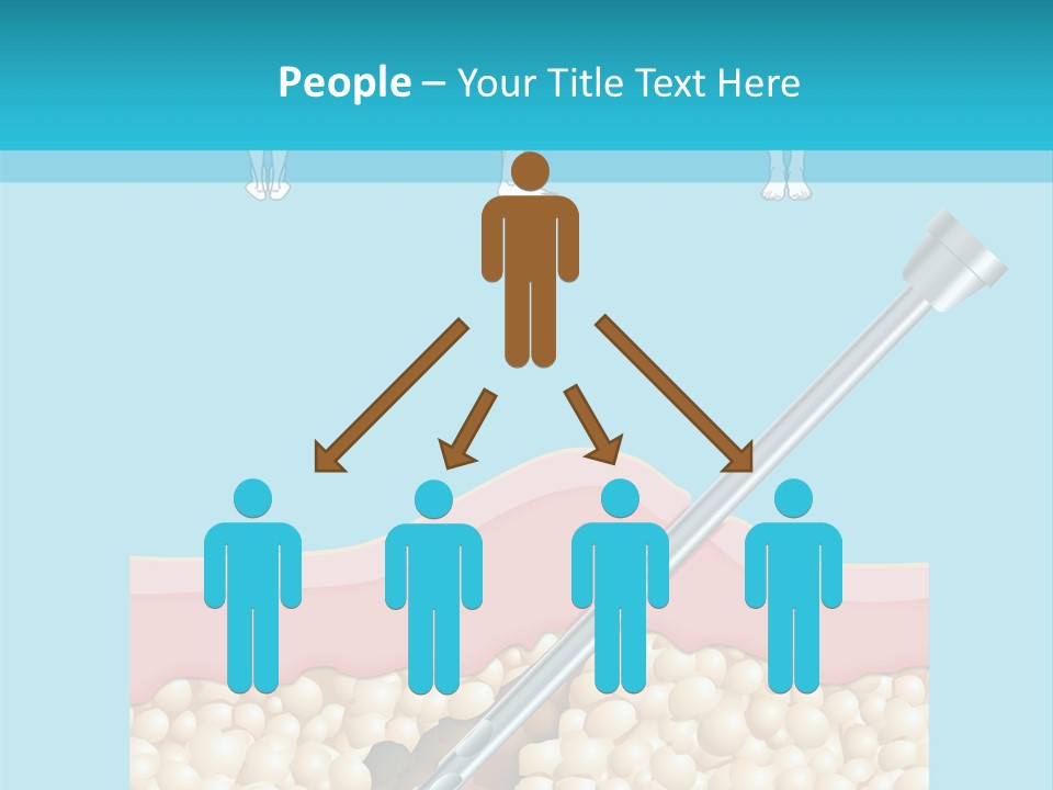 Illustration Of Liposuction Intervention With Liposculpture In A Woman PowerPoint Template