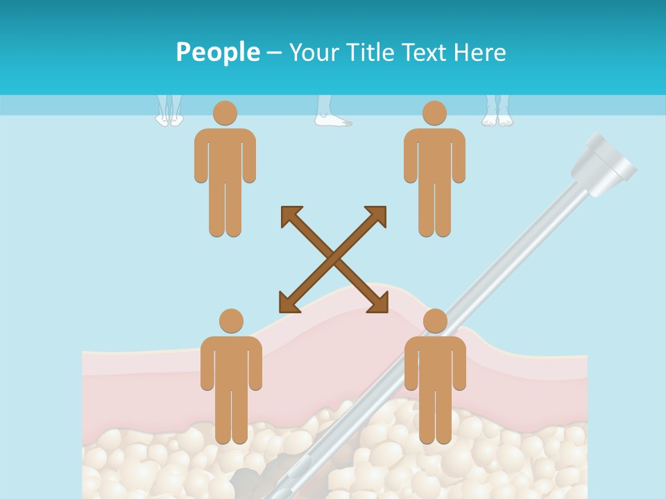 Illustration Of Liposuction Intervention With Liposculpture In A Woman PowerPoint Template