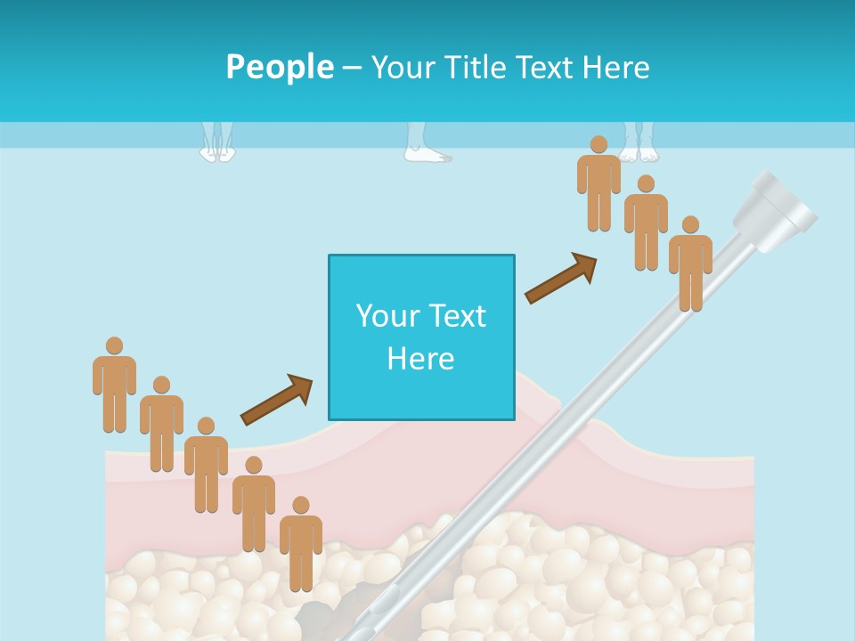 Illustration Of Liposuction Intervention With Liposculpture In A Woman PowerPoint Template