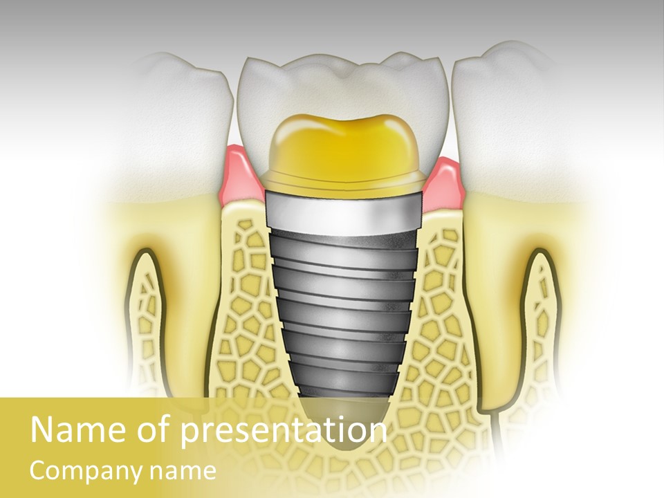 A Tooth With A Implant In The Middle Of It PowerPoint Template