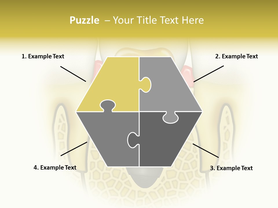 A Tooth With A Implant In The Middle Of It PowerPoint Template