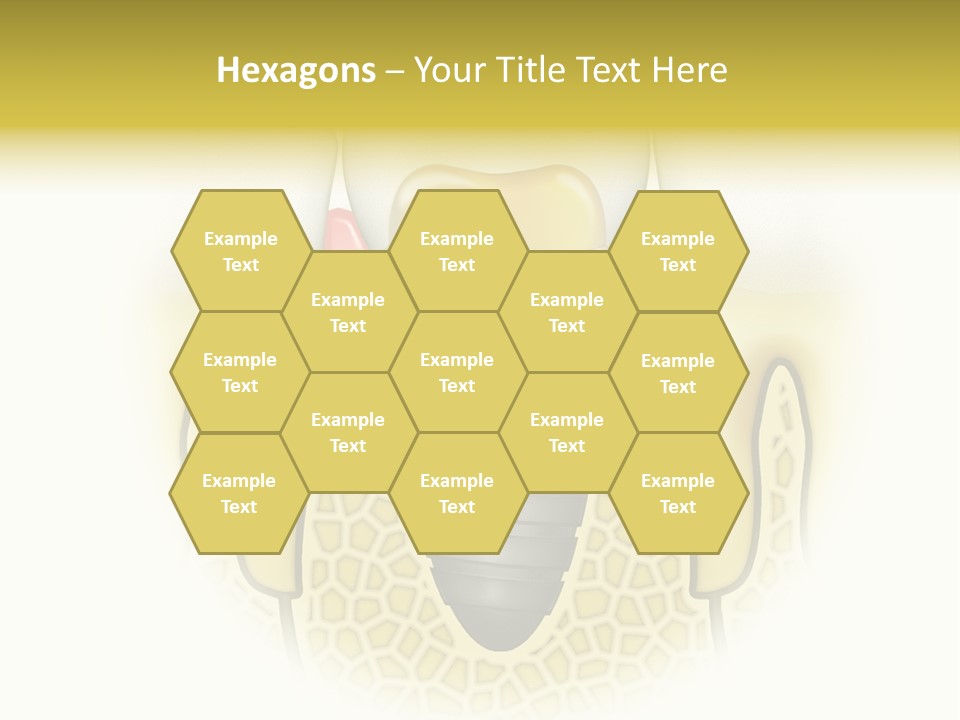 A Tooth With A Implant In The Middle Of It PowerPoint Template