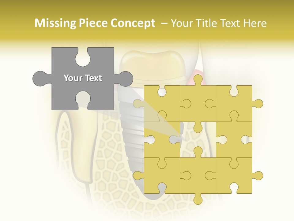 A Tooth With A Implant In The Middle Of It PowerPoint Template