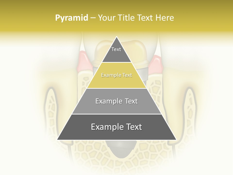 A Tooth With A Implant In The Middle Of It PowerPoint Template
