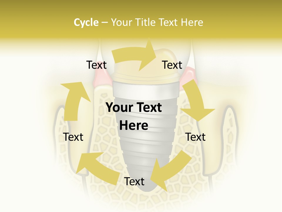 A Tooth With A Implant In The Middle Of It PowerPoint Template