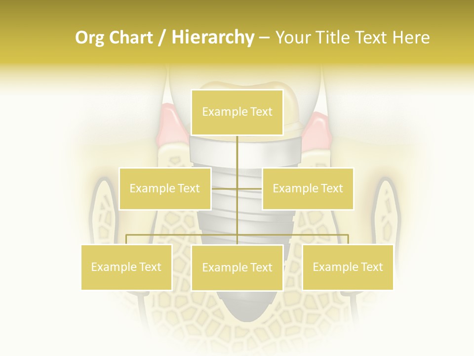 A Tooth With A Implant In The Middle Of It PowerPoint Template